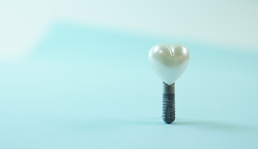 インプラントを長持ちさせるために